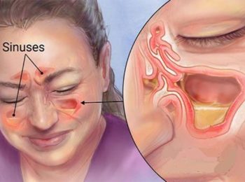 Sinusite, che rimedi utilizzare?