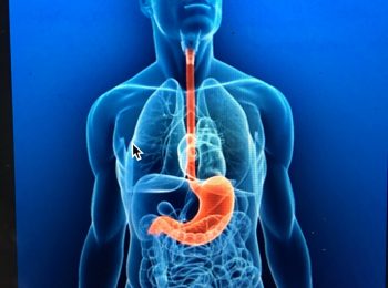 Che cos’è la Malattia da reflusso gastro-esofageo ?