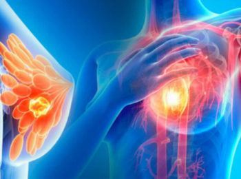 TUCATINIB: nuove speranze per il cancro al seno metastico HER2+