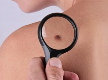 MELANOMA: la prevenzione salva la vita