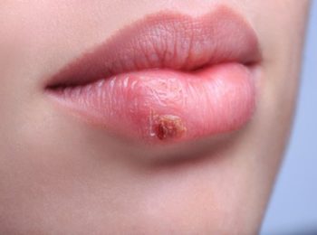 HERPES LABIALE: cos’è e perché può ripresentarsi?