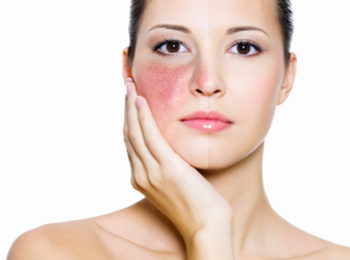 Focus rosacea: sintomi, cause e rimedi