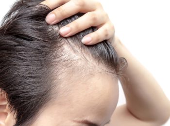 ALOPECIA E MINOXIDIL