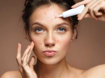 CONSIGLI DERMATOLOGICI PER L’ACNE