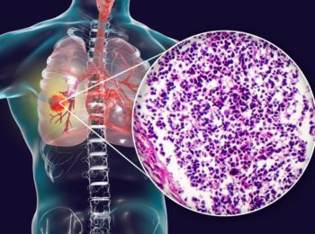 Microcitoma: il Carcinoma polmonare a piccole cellule