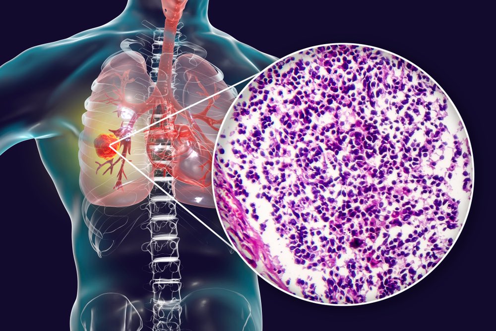Microcitoma il Carcinoma polmonare a piccole cellule Il tuo Farmacista