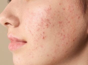 Il benzoilperossido, un rimedio efficace contro l’acne