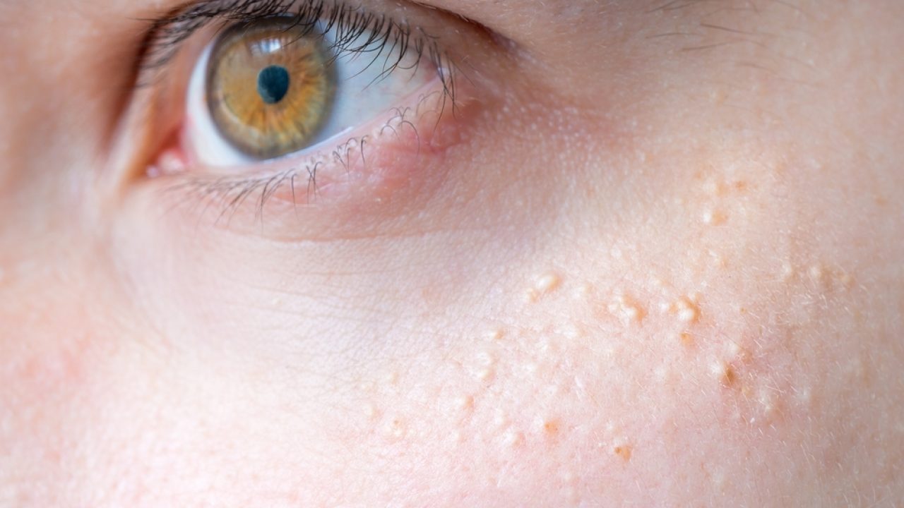 Xantelasmi, Grani di miglio e Fibromi penduli Perché si formano? come