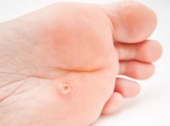 VERRUCHE: come riconoscerle, cause e trattamenti