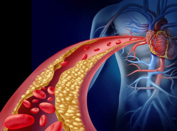 Perchè il colesterolo alto è pericoloso?