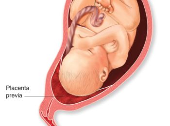 Placenta previa: quanto conosciamo davvero di questa patologia?