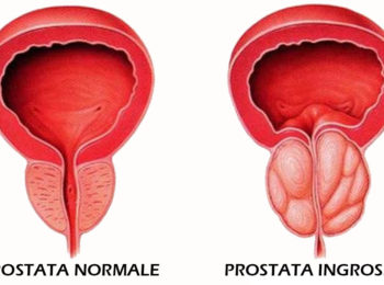 PROSTATITE: DIAGNOSI E PREVENZIONE