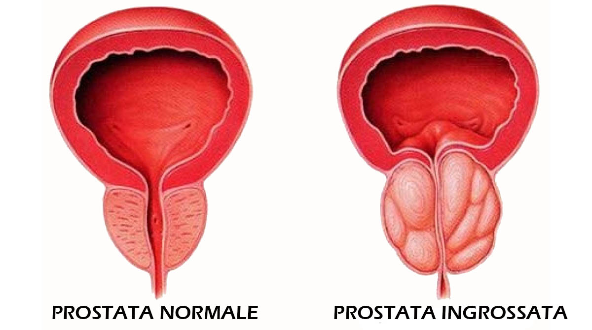 prostatita cronica