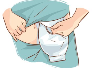 Ileostomia: cos’è veramente